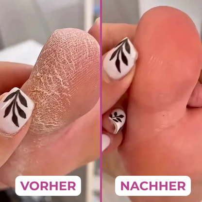 PediLux Quicky™ – Hornhaut weg in Rekordzeit