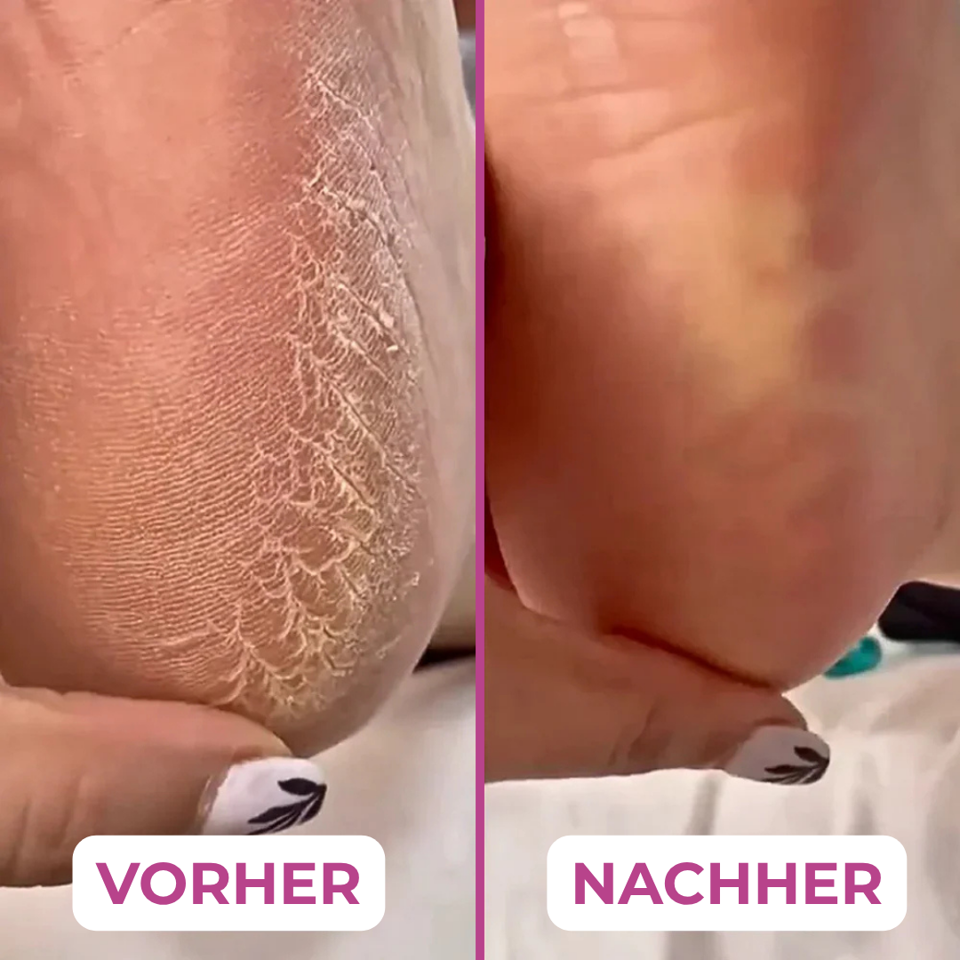 PediLux Quicky™ – Hornhaut weg in Rekordzeit