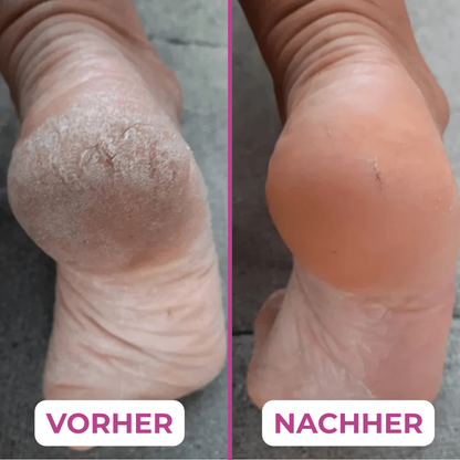 PediLux Quicky™ – Hornhaut weg in Rekordzeit